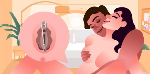 Kẹp cô bé là gì?